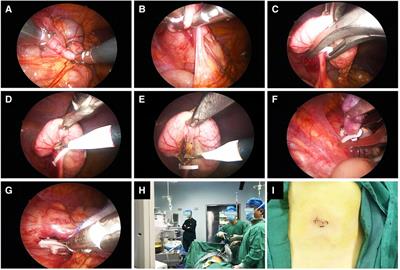 Single-incision laparoscopic appendectomy versus traditional three-hole laparoscopic appendectomy for acute appendicitis in children by senior pediatric surgeons: a multicenter study from China